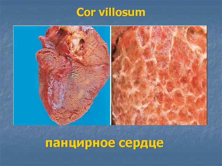 Cor villosum панцирное сердце 