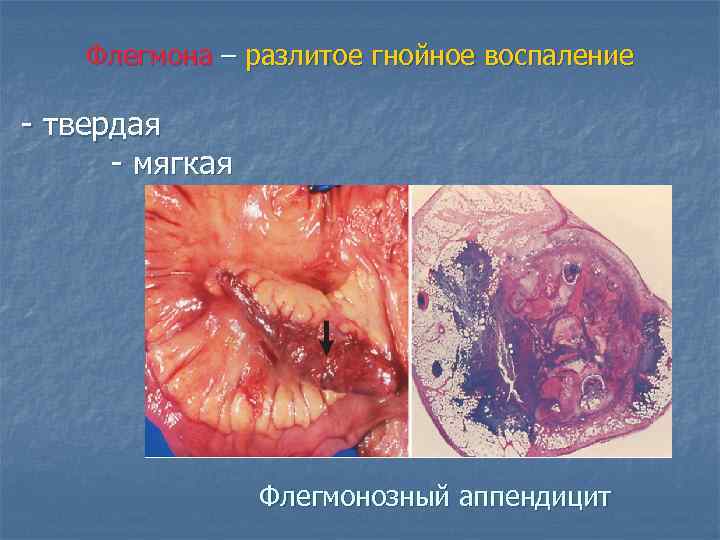 Флегмона – разлитое гнойное воспаление - твердая - мягкая Флегмонозный аппендицит 