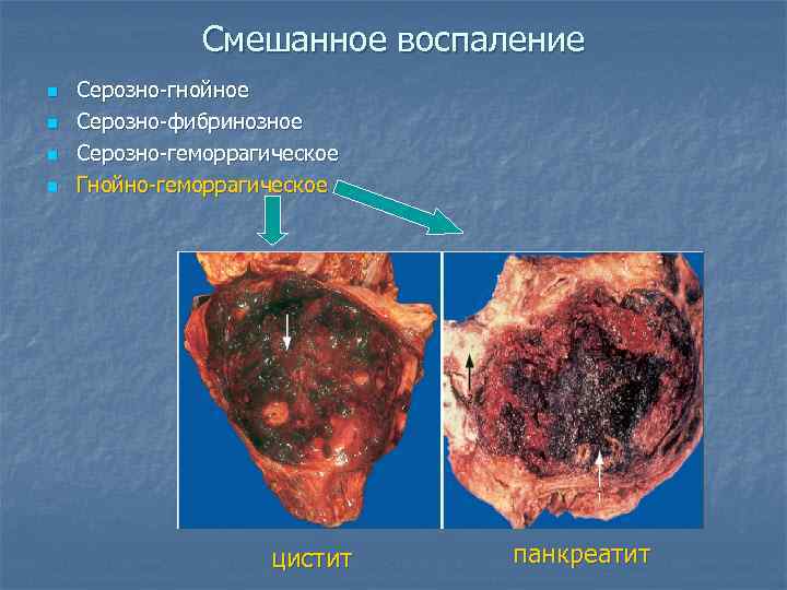 Смешанное воспаление n n Серозно-гнойное Серозно-фибринозное Серозно-геморрагическое Гнойно-геморрагическое цистит панкреатит 