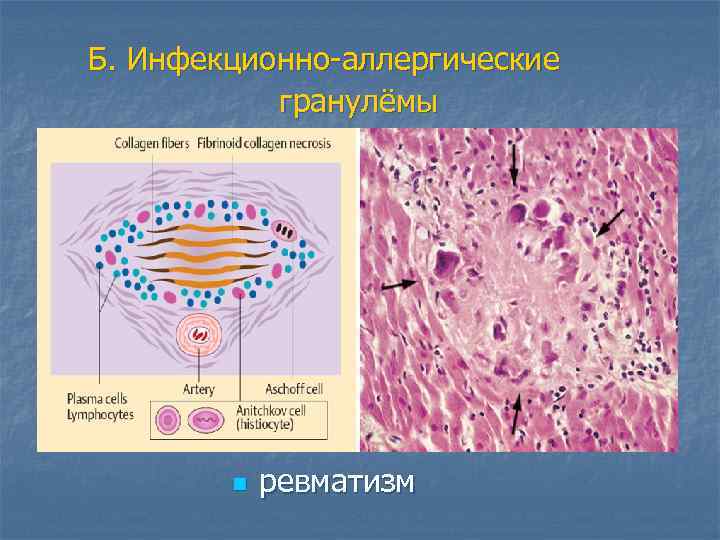 Б. Инфекционно-аллергические гранулёмы n ревматизм 