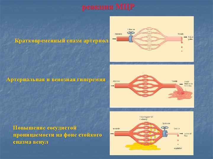 реакция МЦР Кратковременный спазм артериол Артериальная и венозная гиперемия Повышение сосудистой проницаемости на фоне