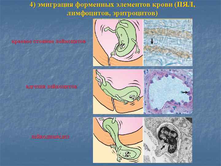 4) эмиграция форменных элементов крови (ПЯЛ, лимфоцитов, эритроцитов) краевое стояние лейкоцитов адгезия лейкоцитов лейкодиапедез