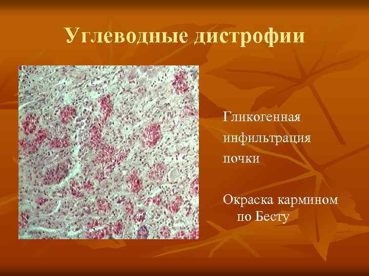 Углеводные дистрофии Гликогенная инфильтрация почки Окраска кармином по Бесту 