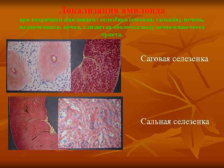 Локализация амилоида при вторичном амилоидозе: селезёнка (саговая, сальная), печень, надпочечники, почки, слизистая оболочка желудочно-кишечного