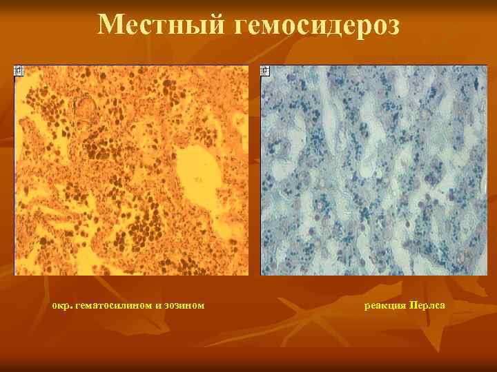 Местный гемосидероз окр. гематосилином и эозином реакция Перлса 