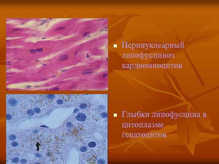 n n Перинуклеарный липофусциноз кардиомиоцитов Глыбки липофусцина в цитоплазме гепатоцитов 