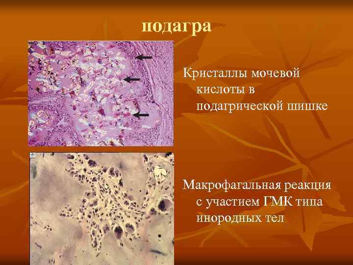 подагра Кристаллы мочевой кислоты в подагрической шишке Макрофагальная реакция с участием ГМК типа инородных