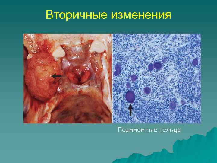 Вторичные изменения Псаммомные тельца 
