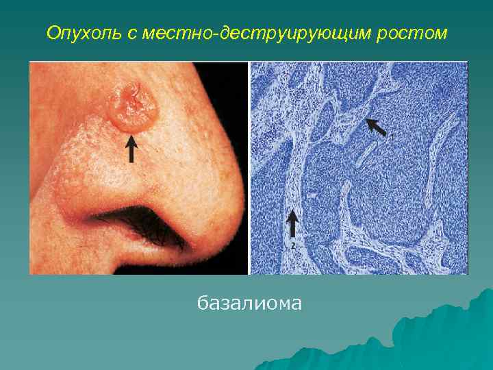 Опухоль с местно-деструирующим ростом базалиома 