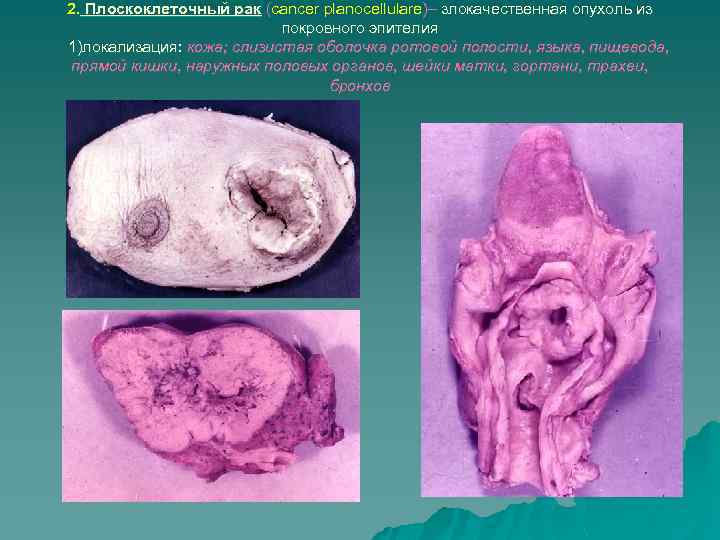 2. Плоскоклеточный рак (cancer planocellulare)– злокачественная опухоль из покровного эпителия 1)локализация: кожа; слизистая оболочка