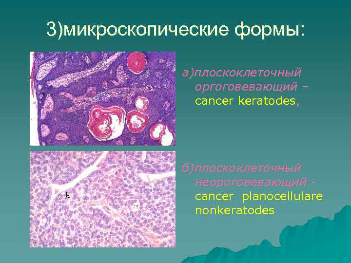 Неороговевающий рак матки