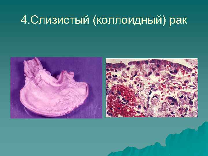 4. Слизистый (коллоидный) рак 