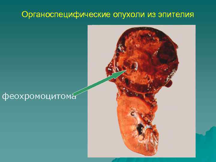 Органоспецифические опухоли из эпителия феохромоцитома 