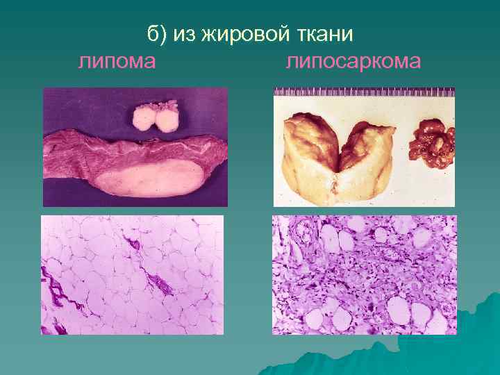 Эндофитный рост опухоли рисунок