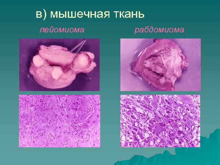 в) мышечная ткань лейомиома рабдомиома 