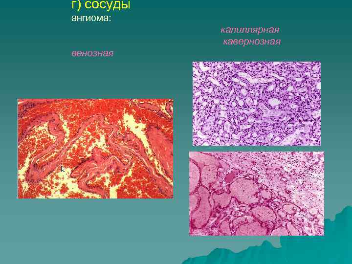 Сосуды г. Капиллярная ангиома микропрепарат. Ангиома капилляров микропрепарат. Капиллярная ангиома кожи. Опухоли сосудистой ткани ангиома.