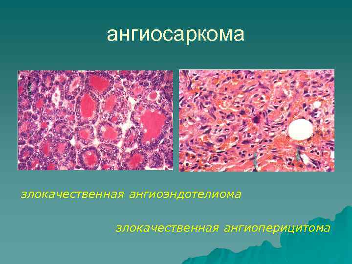 Опухоли из тканей. Ангиосаркома патологическая анатомия. Злокачественная ангиоэндотелиома.