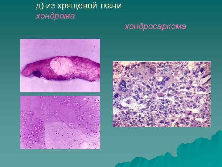 д) из хрящевой ткани хондрома хондросаркома 