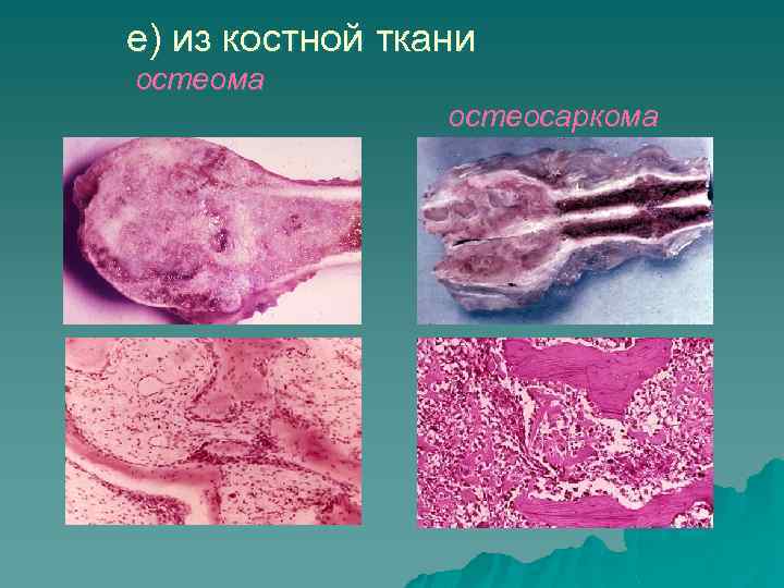 Эндофитный рост опухоли рисунок