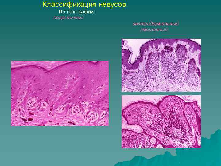 Классификация невусов По топографии: пограничный внутридермальный смешанный 