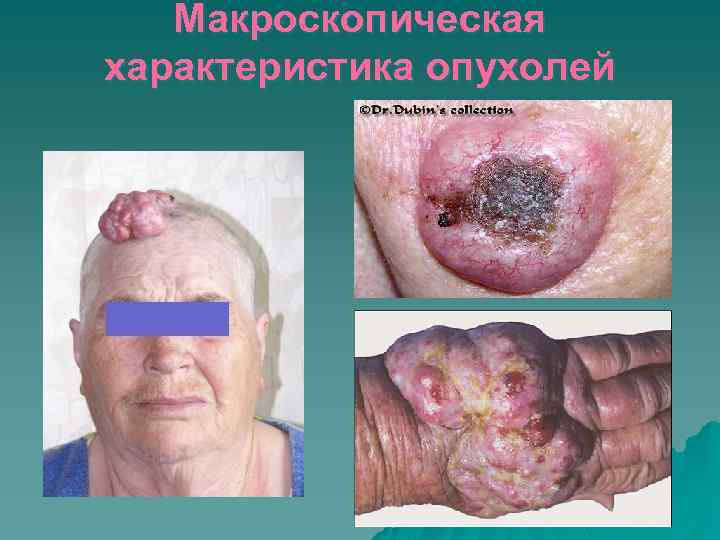Макроскопическая характеристика опухолей 