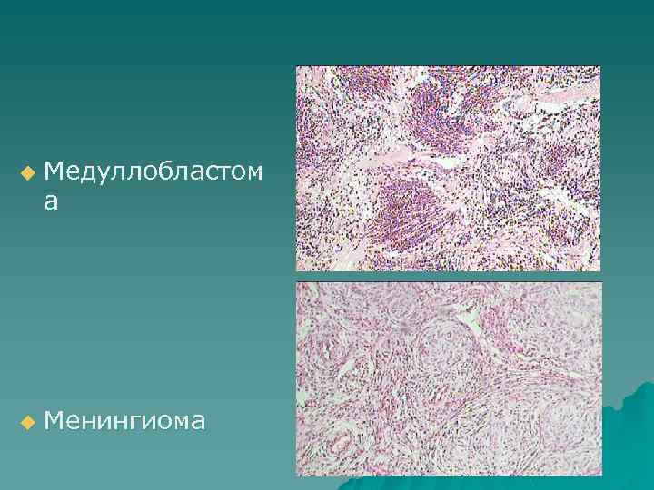 u u Медуллобластом а Менингиома 