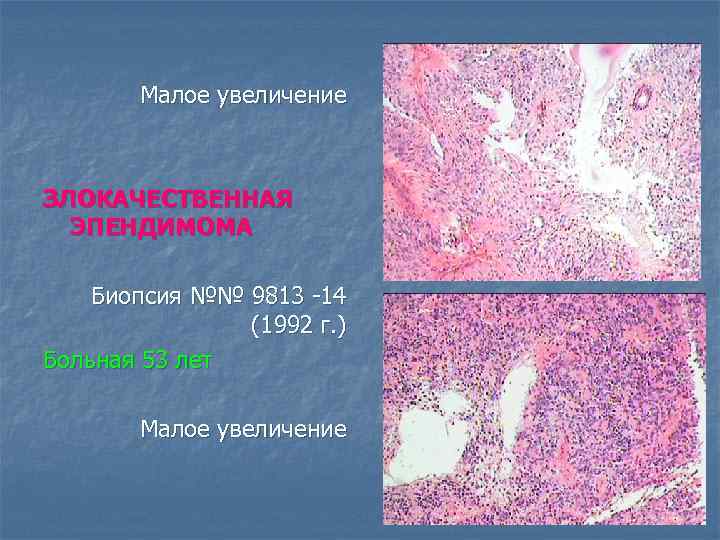 Малое увеличение ЗЛОКАЧЕСТВЕННАЯ ЭПЕНДИМОМА Биопсия №№ 9813 -14 (1992 г. ) Больная 53 лет