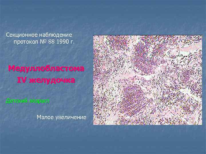 Секционное наблюдение протокол № 88 1990 г. Медуллобластома IV желудочка Детский возраст Малое увеличение