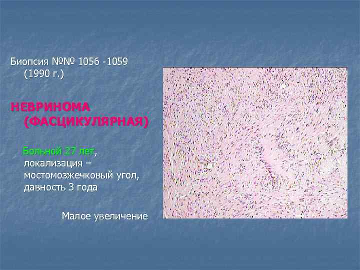 Биопсия №№ 1056 -1059 (1990 г. ) НЕВРИНОМА (ФАСЦИКУЛЯРНАЯ) Больной 27 лет, локализация –