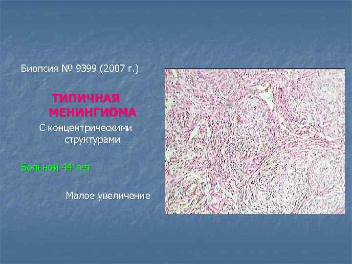 Биопсия № 9399 (2007 г. ) ТИПИЧНАЯ МЕНИНГИОМА С концентрическими структурами Больной 44 лет