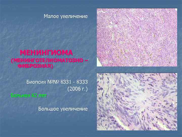 Малое увеличение МЕНИНГИОМА (МЕНИНГОТЕЛИОМАТОЗНО – ФИБРОЗНАЯ) Биопсия №№ 8331 - 8333 (2006 г. )
