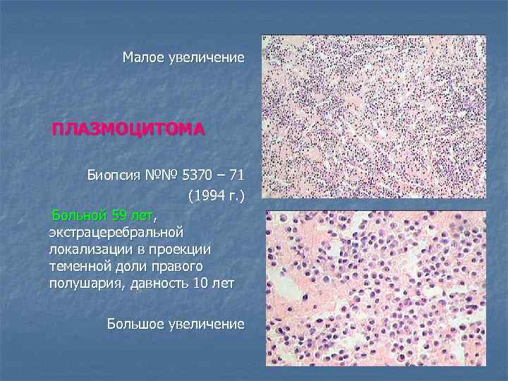 Малое увеличение ПЛАЗМОЦИТОМА Биопсия №№ 5370 – 71 (1994 г. ) Больной 59 лет,