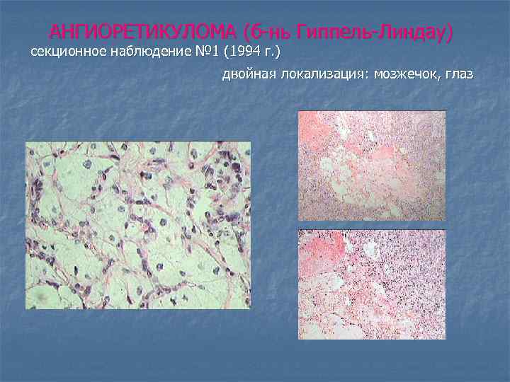АНГИОРЕТИКУЛОМА (б-нь Гиппель-Линдау) секционное наблюдение № 1 (1994 г. ) двойная локализация: мозжечок, глаз