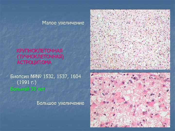 Малое увеличение КРУПНОКЛЕТОЧНАЯ (ТУЧНОКЛЕТОЧНАЯ) АСТРОЦИТОМА Биопсия №№ 1532, 1537, 1604 (1991 г. ) Больной