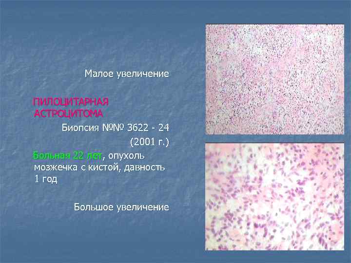 Малое увеличение ПИЛОЦИТАРНАЯ АСТРОЦИТОМА Биопсия №№ 3622 - 24 (2001 г. ) Больная 22