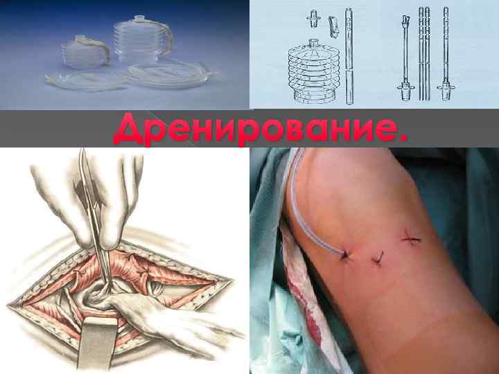 Дренирование. 