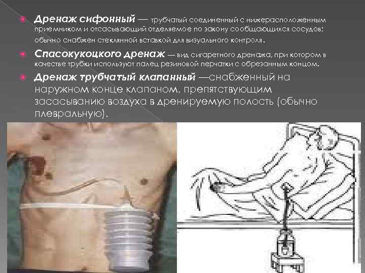  Дренаж сифонный — трубчатый соединенный с нижерасположенным приемником и отсасывающий отделяемое по закону