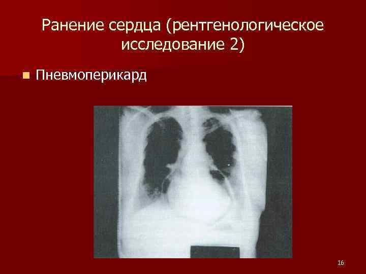 Ранение сердца (рентгенологическое исследование 2) n Пневмоперикард 16 