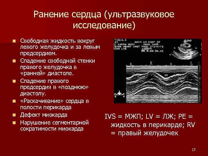 Ранение сердца (ультразвуковое исследование) n n n Свободная жидкость вокруг левого желудочка и за