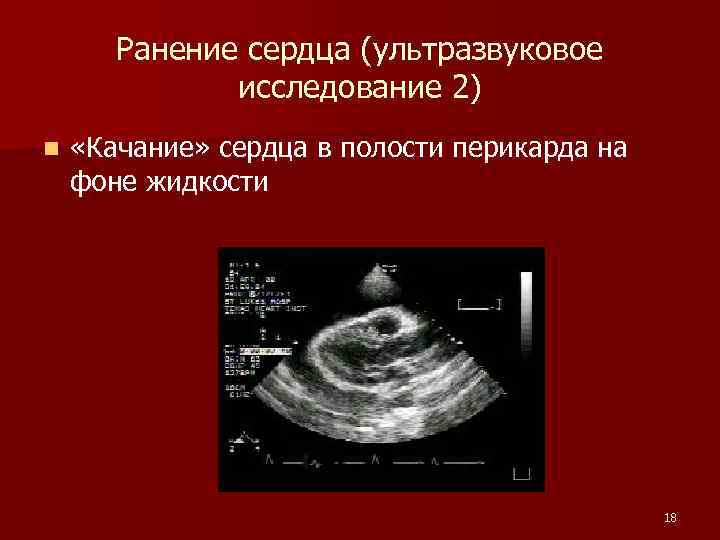 Ранение сердца (ультразвуковое исследование 2) n «Качание» сердца в полости перикарда на фоне жидкости