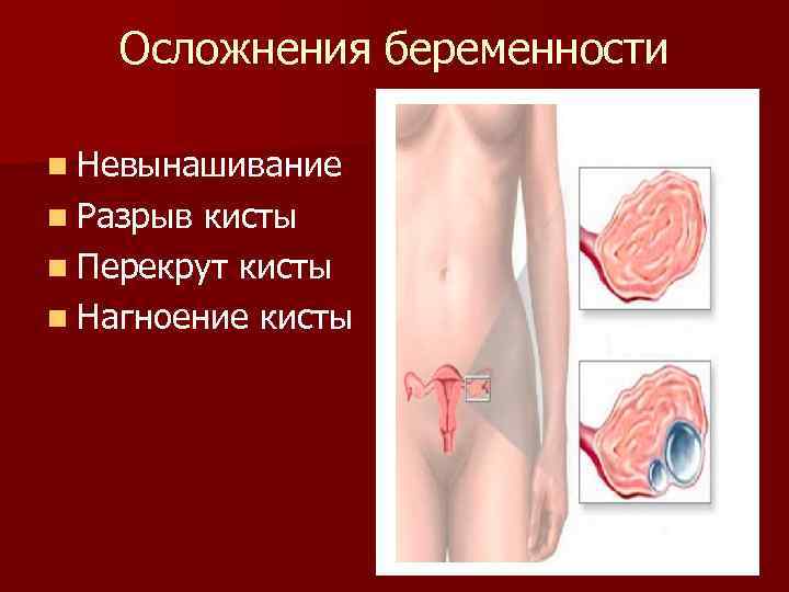 Осложнения беременности n Невынашивание n Разрыв кисты n Перекрут кисты n Нагноение кисты 