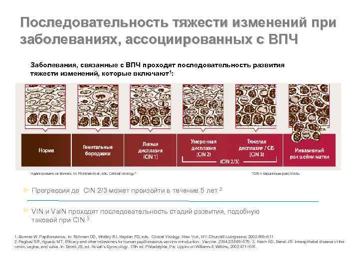 Последовательность тяжести изменений при заболеваниях, ассоциированных с ВПЧ Заболевания, связанные с ВПЧ проходят последовательность
