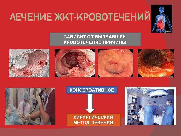 ЛЕЧЕНИЕ ЖКТ-КРОВОТЕЧЕНИЙ ЗАВИСИТ ОТ ВЫЗВАВШЕЙ КРОВОТЕЧЕНИЕ ПРИЧИНЫ КОНСЕРВАТИВНОЕ ХИРУРГИЧЕСКИЙ МЕТОД ЛЕЧЕНИЯ 