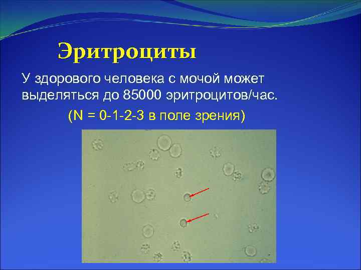 Эритроциты У здорового человека с мочой может выделяться до 85000 эритроцитов/час. (N = 0