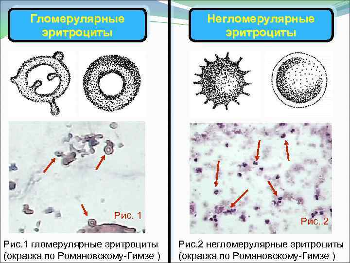 Гломерулярные эритроциты Рис. 1 гломерулярные эритроциты (окраска по Романовскому-Гимзе ) Негломерулярные эритроциты Рис. 2