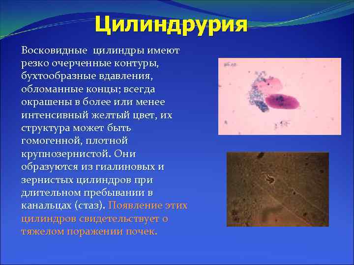 Цилиндрурия Восковидные цилиндры имеют резко очерченные контуры, бухтообразные вдавления, обломанные концы; всегда окрашены в