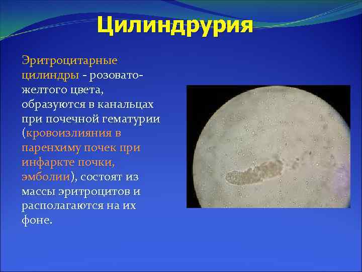 Цилиндрурия Эритроцитарные цилиндры - розоватожелтого цвета, образуются в канальцах при почечной гематурии (кровоизлияния в