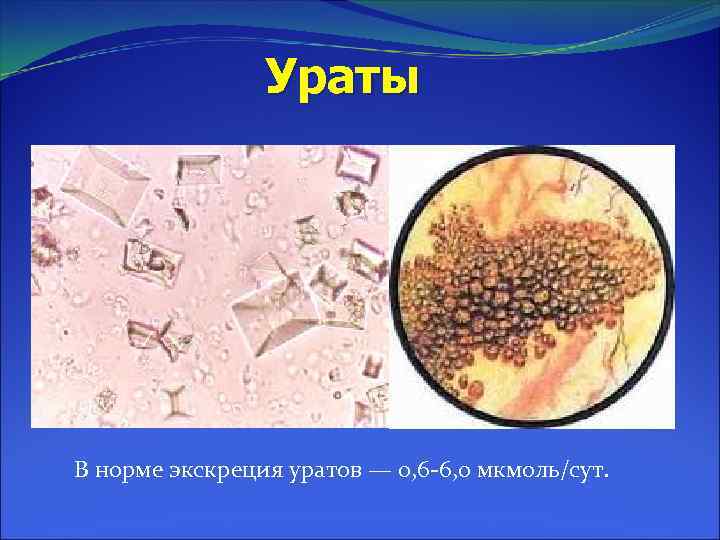 Ураты В норме экскреция уратов — 0, 6 -6, 0 мкмоль/сут. 