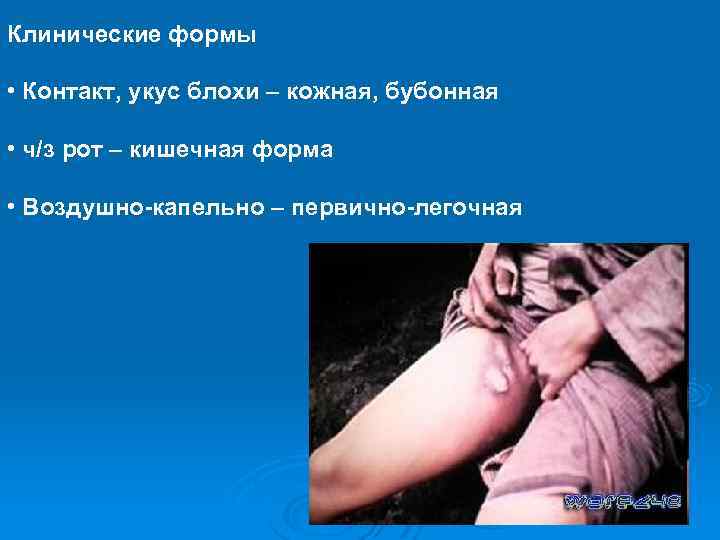 Клинические формы • Контакт, укус блохи – кожная, бубонная • ч/з рот – кишечная