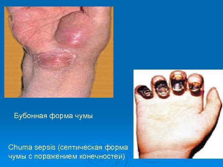 Бубонная форма чумы Chuma sepsis (септическая форма чумы с поражением конечностей) 